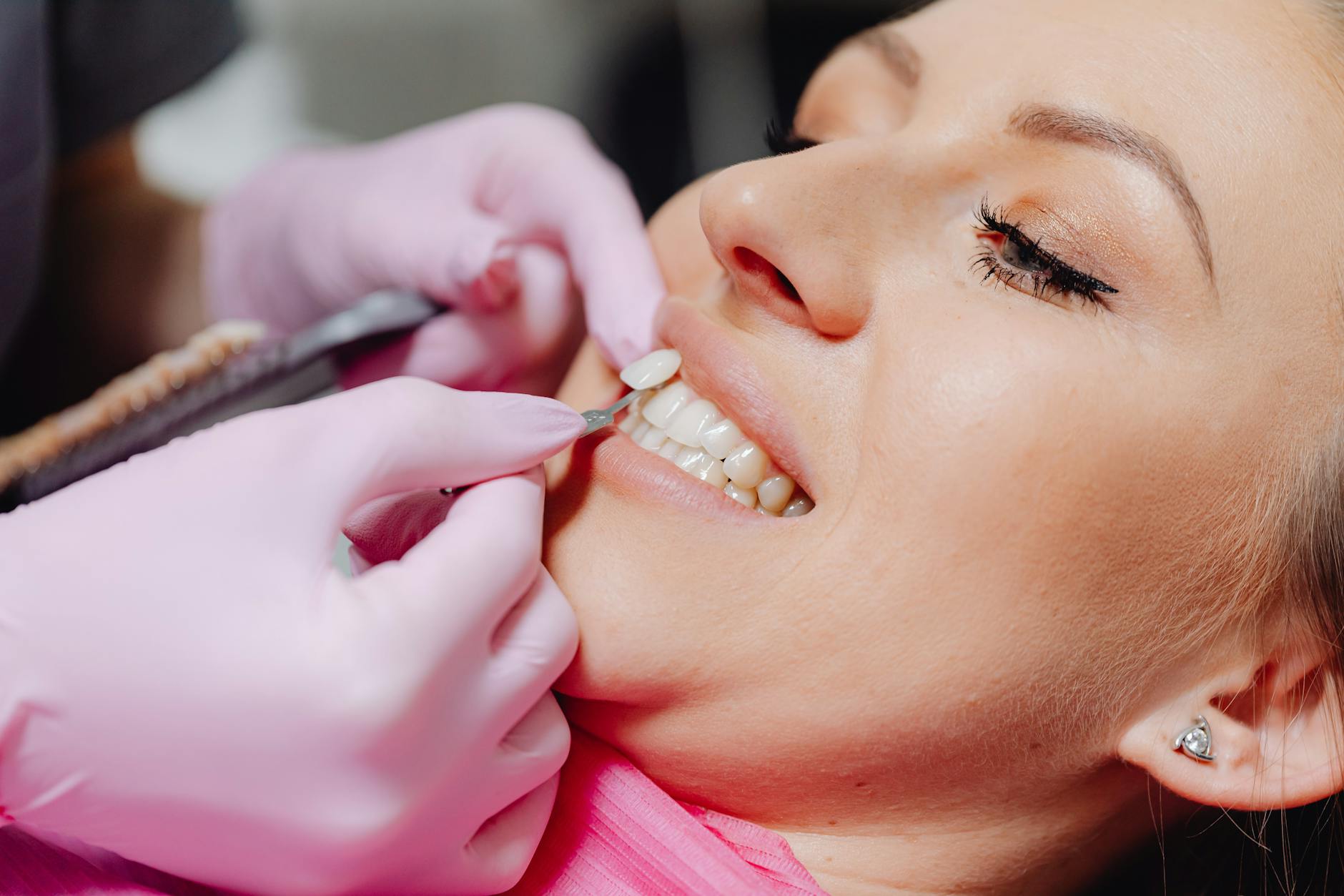 a dentist applying a veneer tooth on a patient